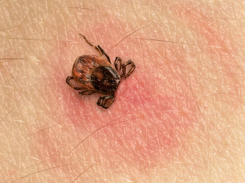 Babesiosis